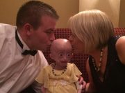 Dívka rostla a vyvíjela se 10krát rychleji než její vrstevníci. Tohle je její příběh