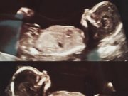 Žena se 6 týdnů po porodu cítila divně. Když se vrátí k lékaři na ultrazvukové vyšetření, je vyděšená
