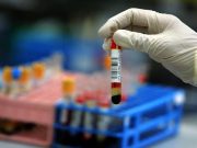 POZOR! Až příště půjdete na krevní test, test moči, laboratorní test, toto byste měli vědět!