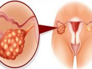 Skrytá nemoc, o které by každá žena měla vědět! To je za menstruačními poruchami!