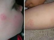 Chlapec měl podivnou vyrážku, když si matka uvědomila, o co jde, a okamžitě s ním spěchala do nemocnice!